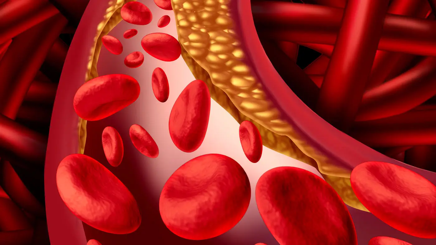 Pensi che il tuo colesterolo vada bene? Ecco il calcolo reale del rischio cardiovascolare